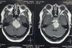 用“精雕细刻”和“蚂蚁啃骨头”来形容今天的手术一点都不过分！视频封面