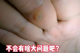 右手中指长了一个小疙瘩没有管过，最近一碰就疼，大夫说要做手术视频封面