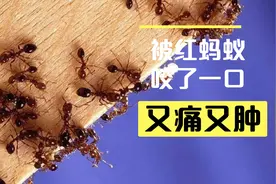 广东退休阿姨搞卫生，被红蚂蚁咬了一口，疼痛红肿，是怎么治好的