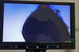 福建慢性前列腺炎病友，前列腺小管堵塞严重，前列腺萎缩变硬。视频封面
