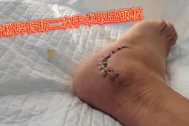 根骨粉碎骨折手术取钢板！记录自己钢板的过程！视频封面