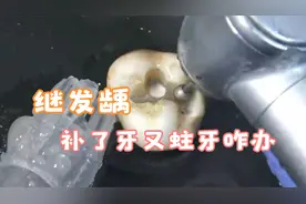 科普蛀牙补牙知识：补过的牙齿又蛀牙了怎么办？视频封面