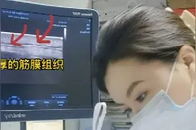 北大人民医院超声科肌筋膜炎治疗：松解+激痛点注射，立竿见影