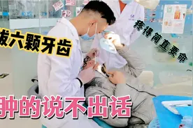 小伙连拔六颗蛀牙，脸肿的不能说话并且一个月不能吃肉，太难受了视频封面