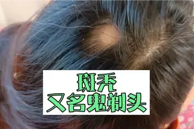 你知道斑秃吗？看我如何用半年的时间把斑秃治好！经验分享视频封面