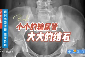 小小的输尿管，大大的结石。输尿管结石钬激光碎石术。视频封面