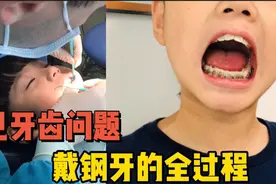 12岁儿子的大龅牙要正畸，终于戴上钢牙，矫正过程居然睡了一觉视频封面