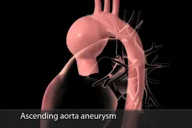 人体最粗的动脉，主动脉瘤破裂发生原因及治疗，3D演示。。