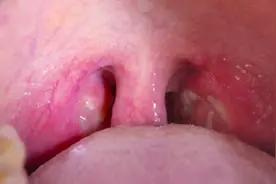 喉咙痛可以由哪些疾病引起？