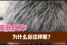 小小儿童长白发怎么了呢？视频封面