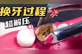 慎入！坏牙换牙全过程超解压！视频封面