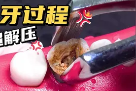 慎入！坏牙换牙全过程超解压！视频封面