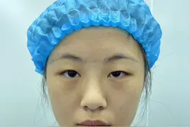 记录自己割双眼皮之前的样子视频封面