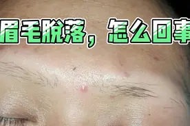 眉毛脱落，怎么回事？视频封面