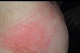 宝宝红屁股（尿布皮炎）怎么办？视频封面