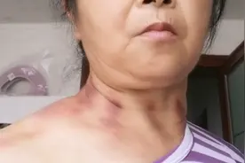 中暑自己揪痧，绿色疗法真好，不须吃药，打针，揪好一身轻松。视频封面