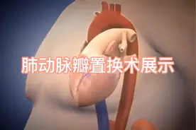 高清动画展示肺动脉瓣置换术！视频封面