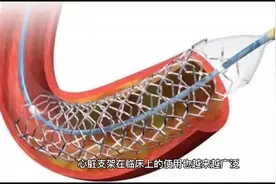 心脏支架术后有哪些饮食禁忌？生活中还需要注意些什么才好？视频封面
