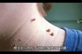脖子长小肉粒！说明你身体出了问题
