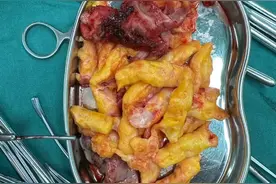 子宫肌瘤，脂肪变性。视频封面