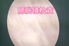 膀胱镜检查，可见前列腺突入膀胱内，膀胱内可见大量小梁小室