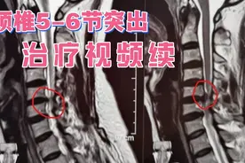 教学视频：颈椎第5-6节突出正骨理疗，3-5天症状全愈视频封面