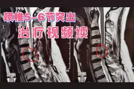 教学视频：颈椎第5-6节突出正骨理疗，3-5天症状全愈视频封面