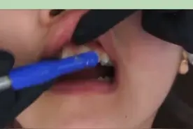 来看看戴牙套的全过程吧