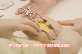 长达8分钟阑尾切除手术全过程演示，看完太过瘾！视频封面