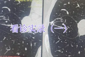 肺结节看诊录像（一）:术后复查应该比较啥？视频封面