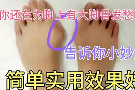 你还在为脚上大拐骨发愁吗？分享一个小妙招，作用太大了！视频封面