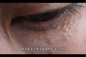 为什么你的眼部总爱长脂肪粒？怎么去除视频封面