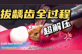 超解压！拔龋齿全过程~看完舒畅多了视频封面