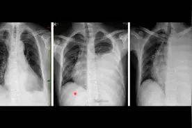 胸部X光片上如何大致判断胸腔积液量？专科医生讲解视频封面