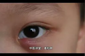 麦粒肿解决方法，你也可以是高手视频封面
