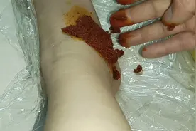 终于找到治疗陈旧扭伤后遗症的方法了视频封面