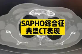 【罕见病例】反复前胸肿痛，发现胸骨异常，一定警惕SAPHO综合征视频封面