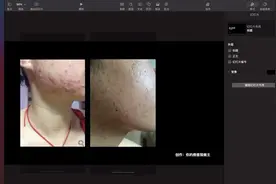 面疱囊肿痘2视频封面