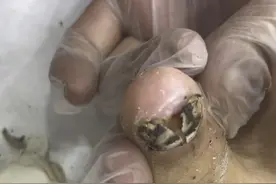 灰指甲清理全过程 小马哥修脚朝阳双塔店视频封面