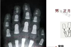 男性骨龄标准图谱视频封面