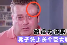 男子头上长个巨大肿包，网红医生直接上手挤痘，太解压了视频封面