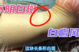 身体出现不明白斑，居然是白癜风，恢复真的很难吗视频封面