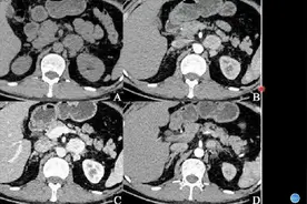 肾上腺两种疾病在CT上的不同表现，放射科医生讲解，实用易懂视频封面