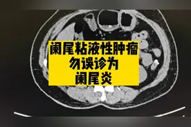 右下腹痛，CT诊断为阑尾粘液性肿瘤，典型表现，别误诊为阑尾炎！视频封面