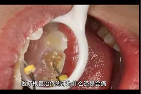 做了根管治疗的牙为什么还是会痛？视频封面