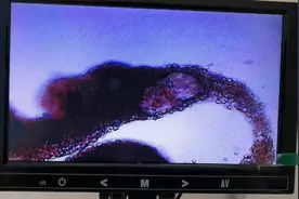 前列腺炎如何引起前列腺小管堵塞？要从前列腺小管解剖结构说起。视频封面