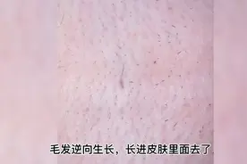 毛发逆向生长，都长进肉里面去了视频封面