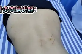 病案分享：腰部疼痛针灸如何取穴定位？主任医师实操讲解！视频封面