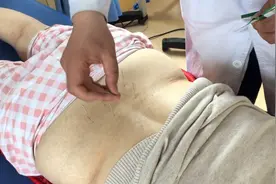 飞针治疗，无痛针灸是怎么操作的，都没有见过的一种进针手法视频封面