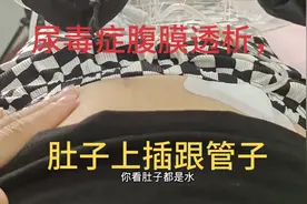 尿毒症女孩凌晨洗肾，肚子上插管子，大家要爱护好自己的身体哦视频封面